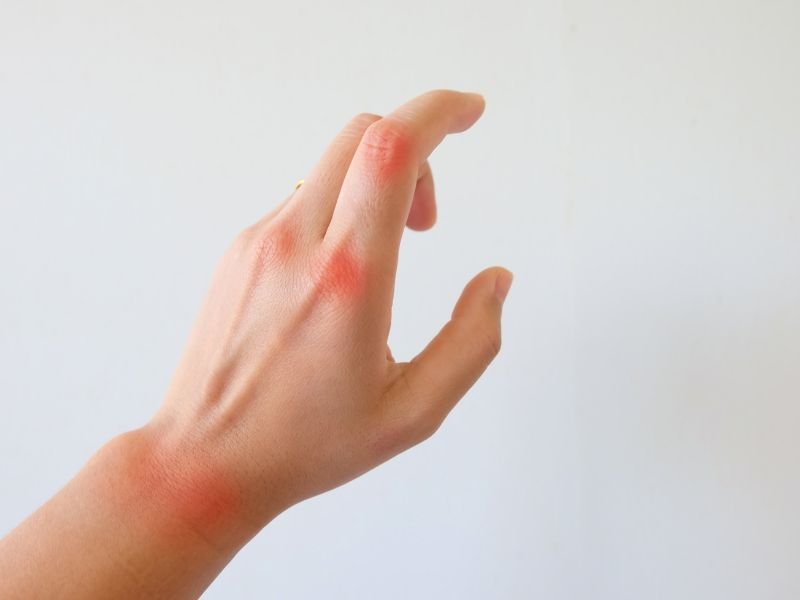 Artrite Reumatoide em Curitiba Avancos no Tratamento