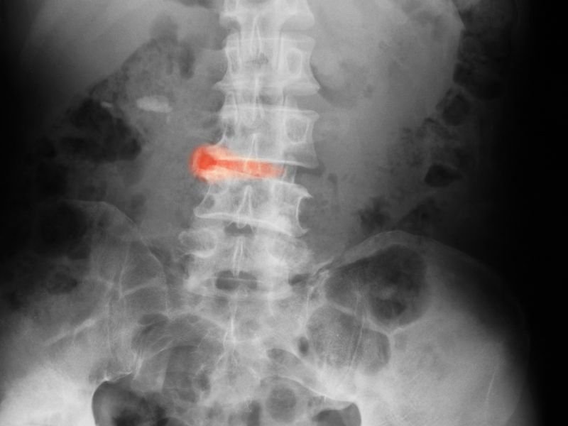 Espondilite Anquilosante em Curitiba Como Tratar