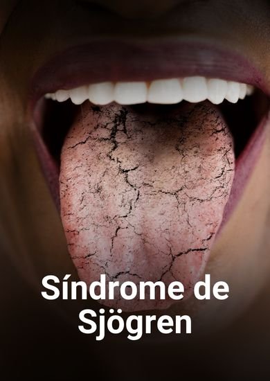 Sindrome de Sjogren
