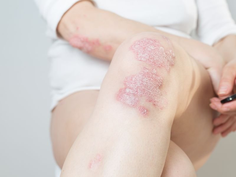 Tratamento para Artrite Psoriasica em Curitiba