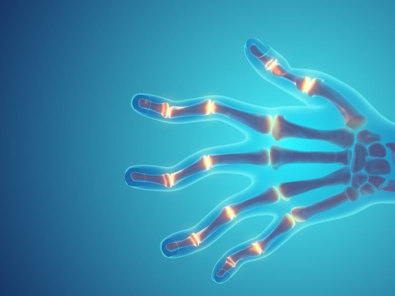 Tratamento para Artrite Reumatoide em Curitiba