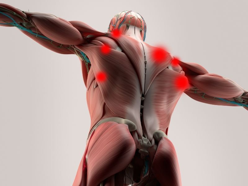 Tratamento para Sindrome Miofascial em Curitiba